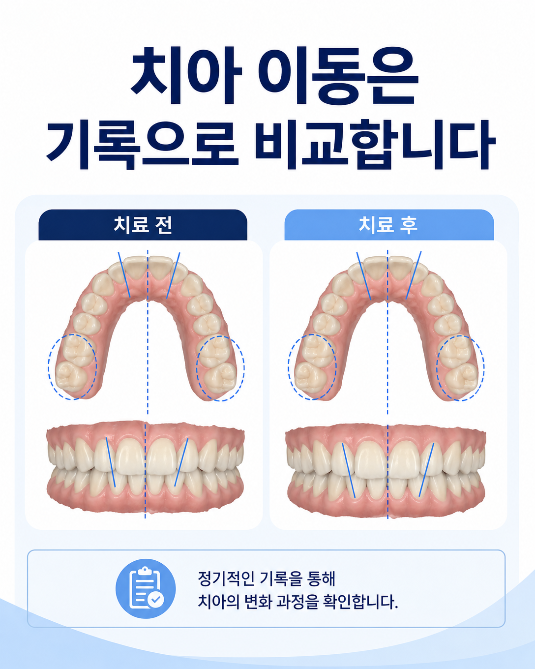 구강 스캔 기록으로 구강장치 사용 전후의 치아 이동과 교합을 비교하는 이미지