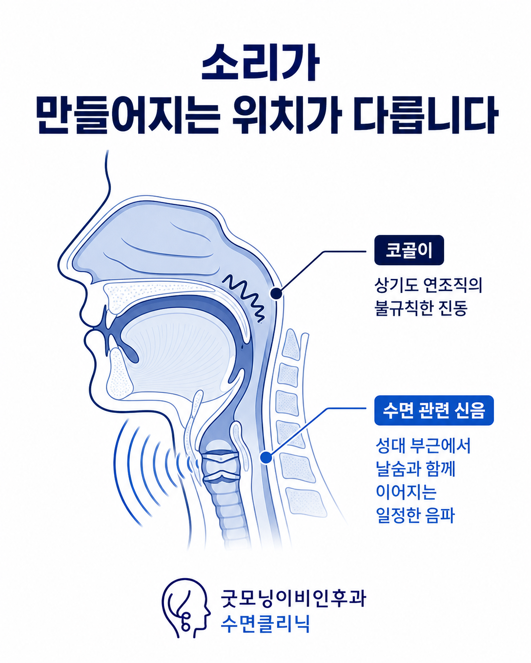 상기도 진동으로 나는 코골이와 날숨 발성인 수면 관련 신음의 차이