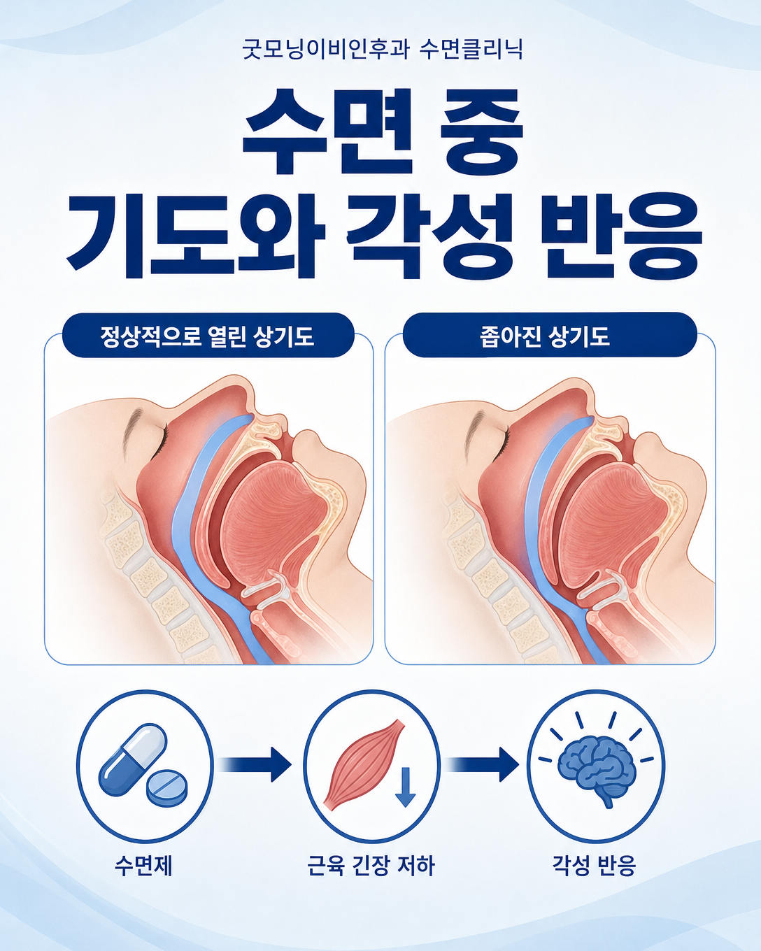 수면제가 수면 중 상기도 근육과 각성 반응에 영향을 줄 수 있는 과정을 설명한 그림