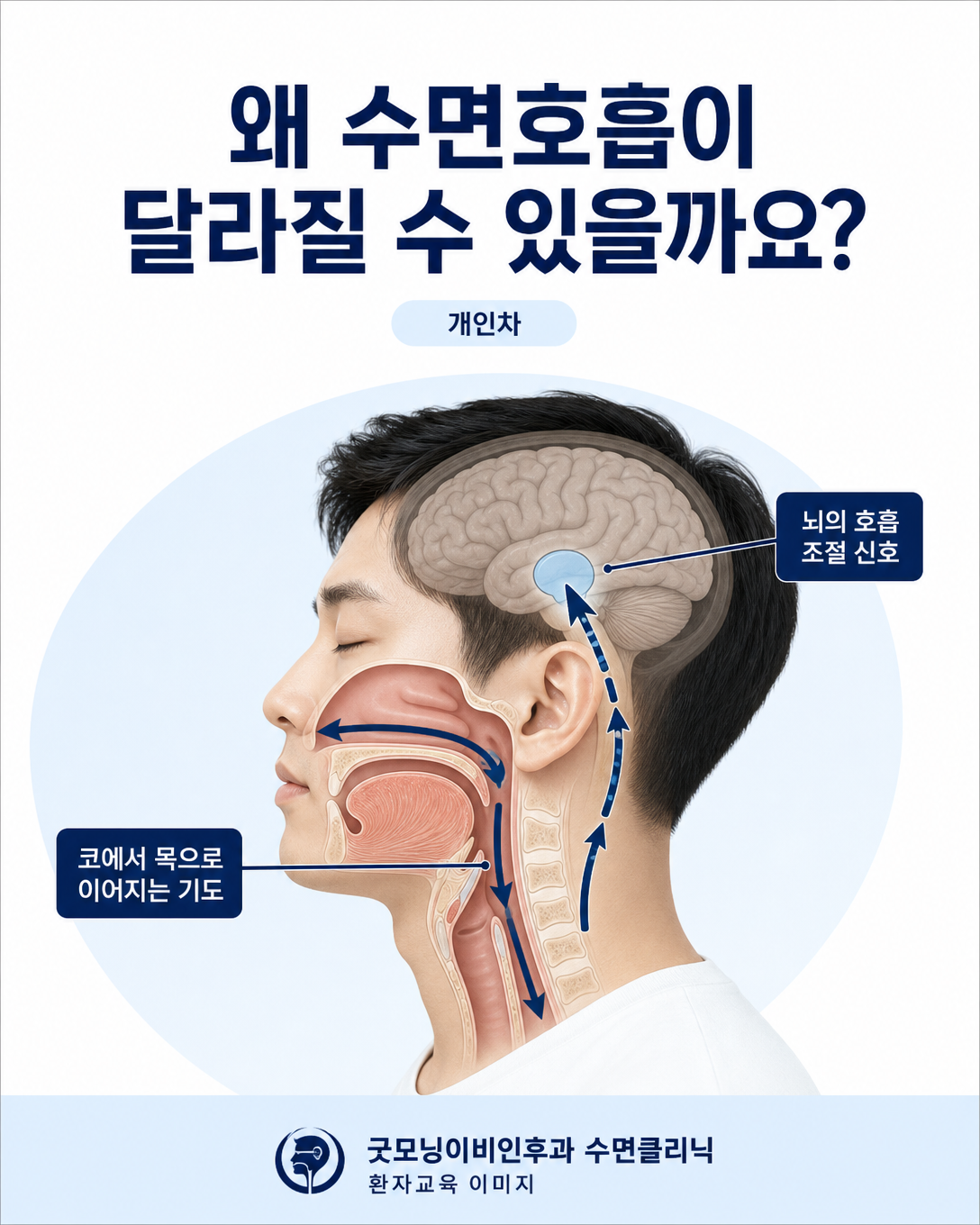 테스토스테론 치료가 수면 중 호흡 조절에 영향을 줄 가능성을 설명하는 상기도 도식
