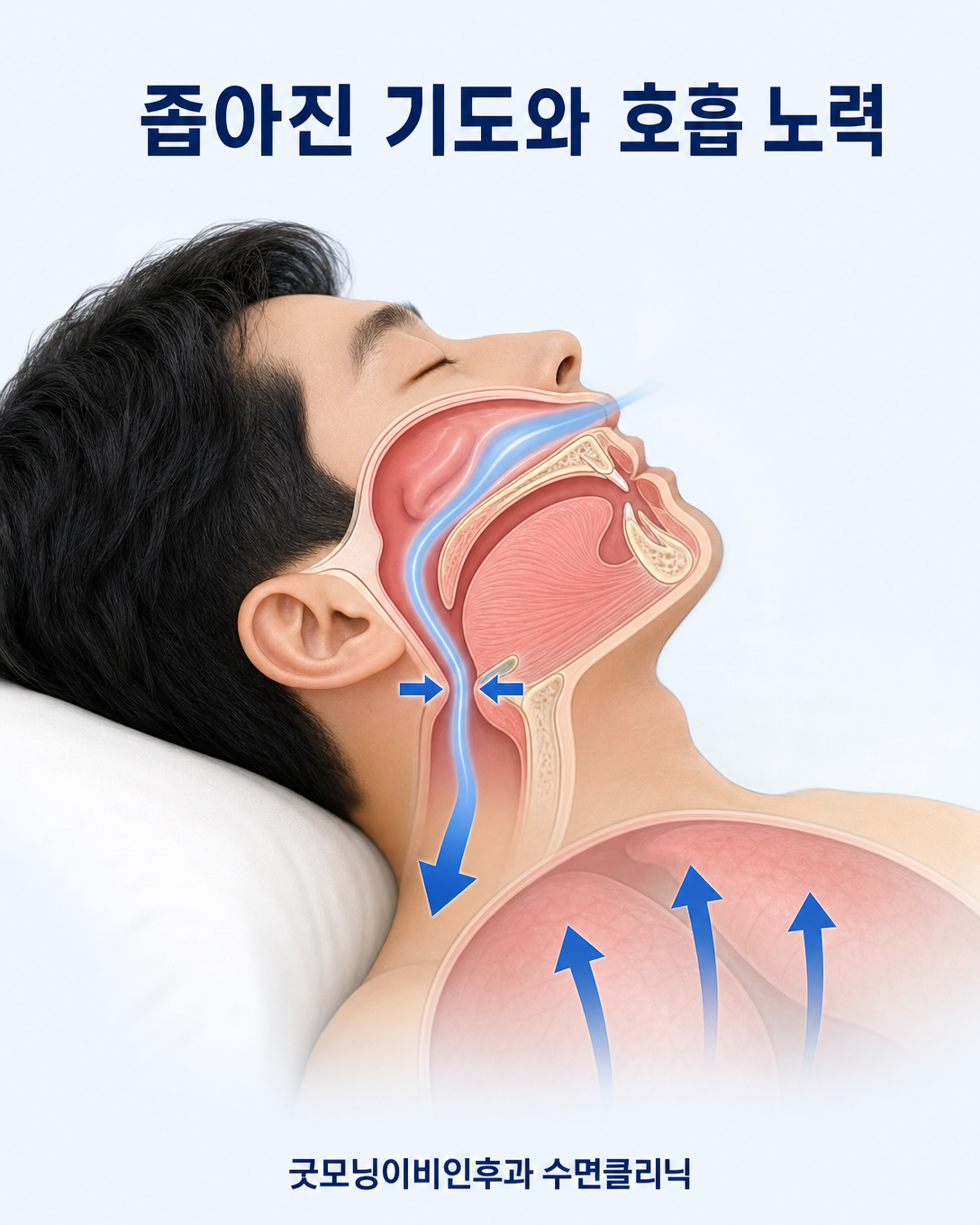 좁아진 상기도를 통과하기 위해 호흡 노력이 증가하는 UARS 기전 도식