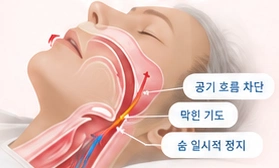 상기도가 막혀 공기 흐름이 제한되는 설명도
